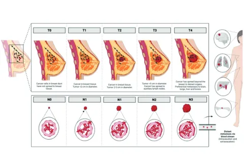 Progression of breast cancer