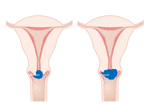 Diagram showing stage 1B cervical cancer