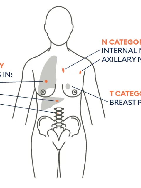 TNM explanatory graph